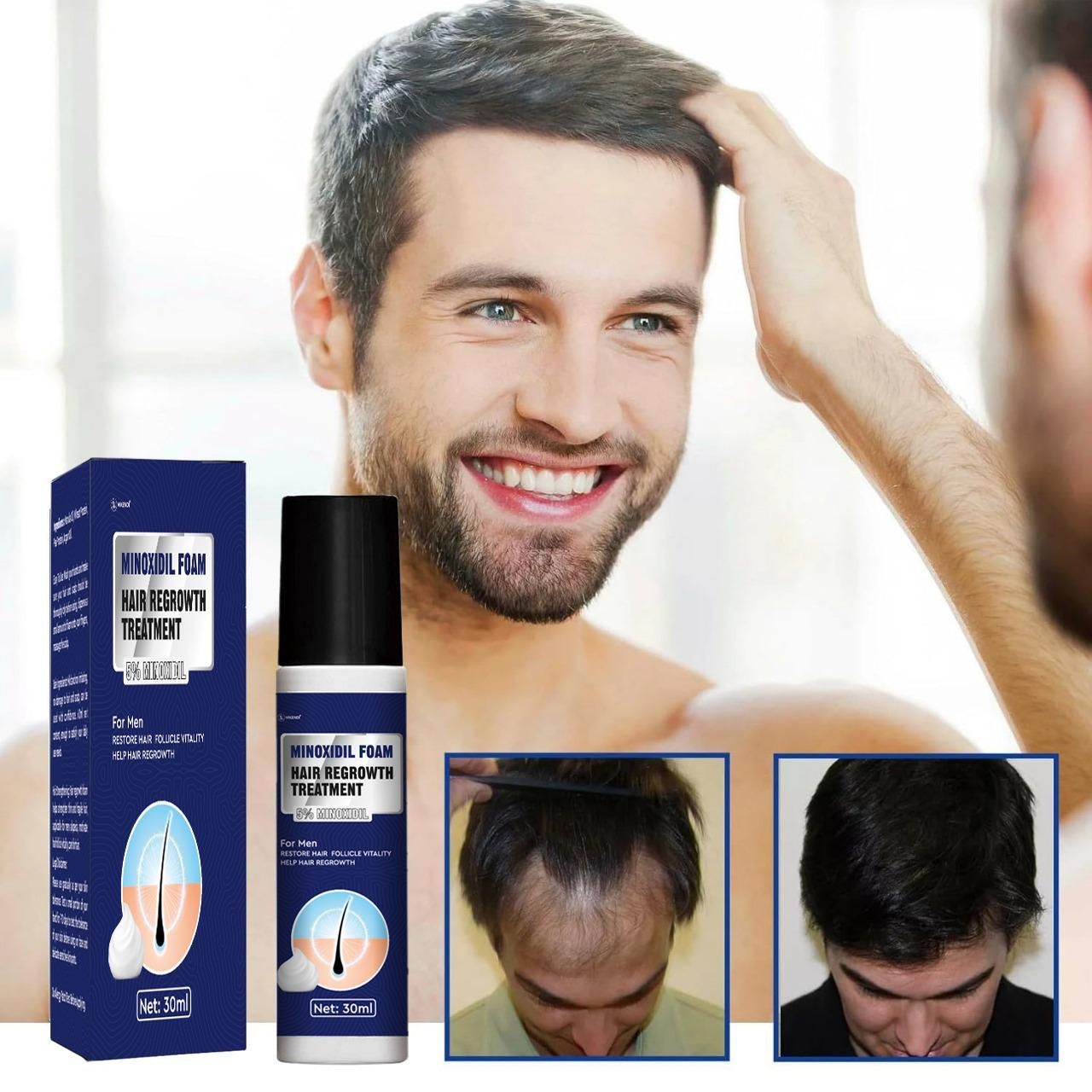Minoxidil Foam Hair Regrowth Treatment 30ML (Pack of 2)