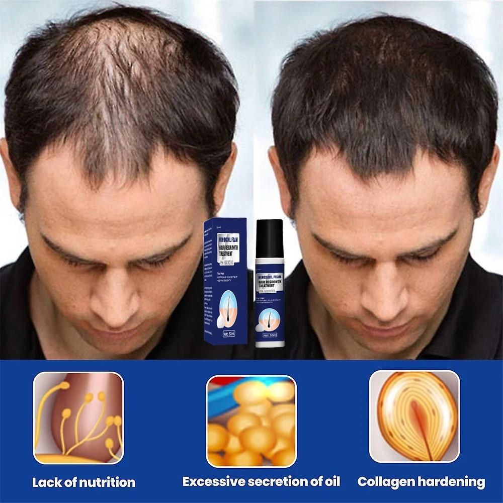 Minoxidil Foam Hair Regrowth Treatment 30ML (Pack of 2)
